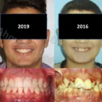 تقويم الاسنان قبل وبعد