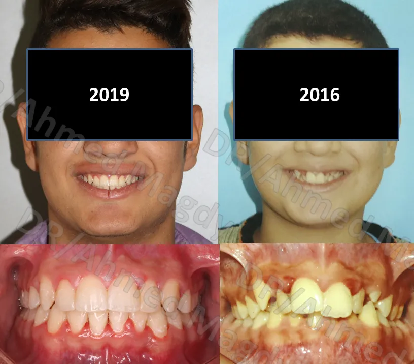 تقويم الاسنان قبل وبعد