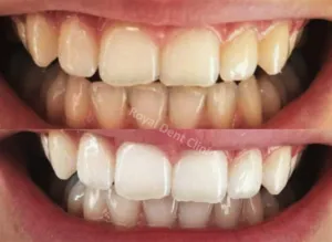 تبييض الاسنان الاقتصادي بعيادة روويال دينت لتقويم وتجميل الاسنان
