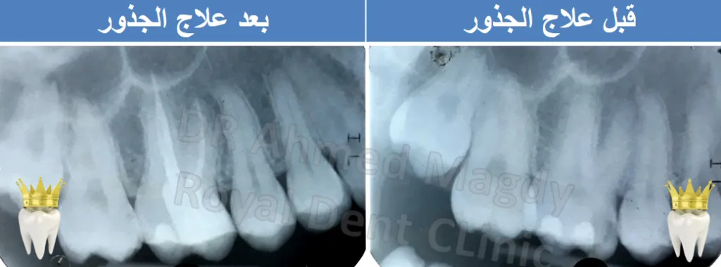 دكتور حشو عصب اكتوبر