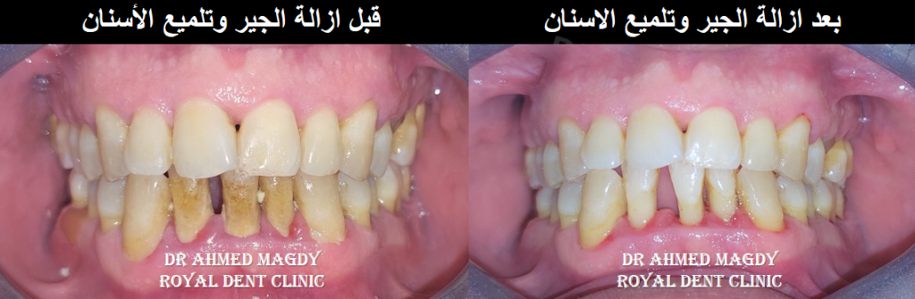 تنظيف الجير اكتوبر
