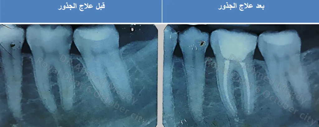 حشو عصب اكتوبر