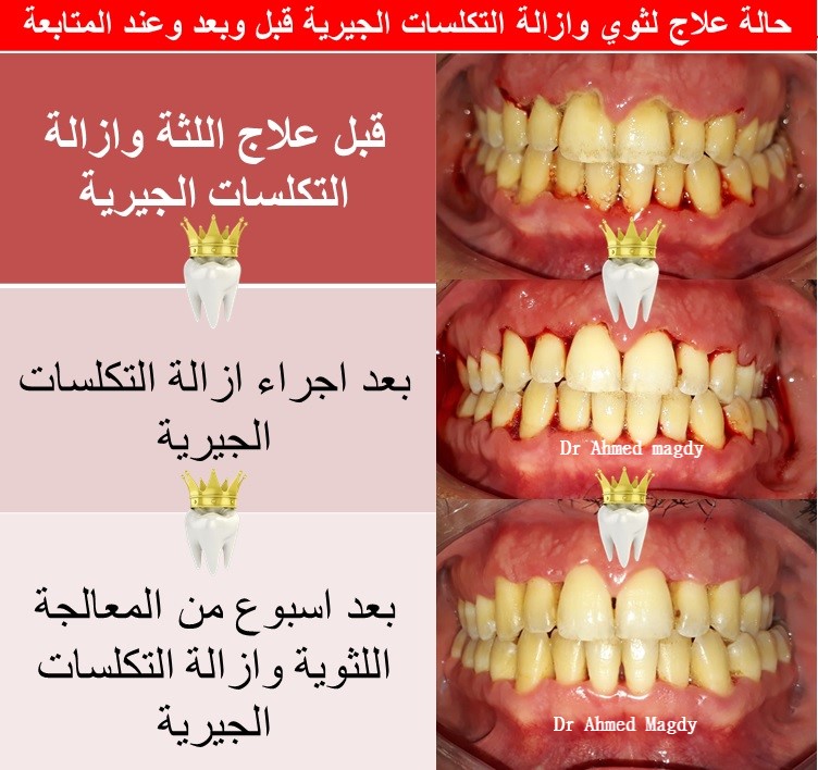 تنظيف وتلميع الاسنان