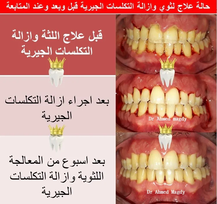 تنظيف وتلميع الاسنان