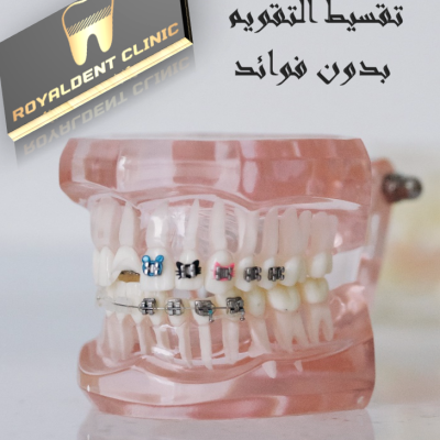 تقويم الاسنان بالتقسيط