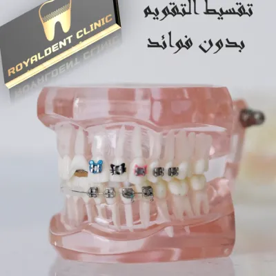 تقويم الاسنان بالتقسيط